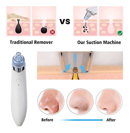 4 in 1 Blackhead Removal Machine